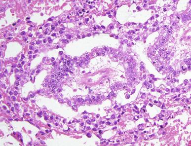 Fig. 13.65, Endodermal sinus pattern of a yolk sac tumor.