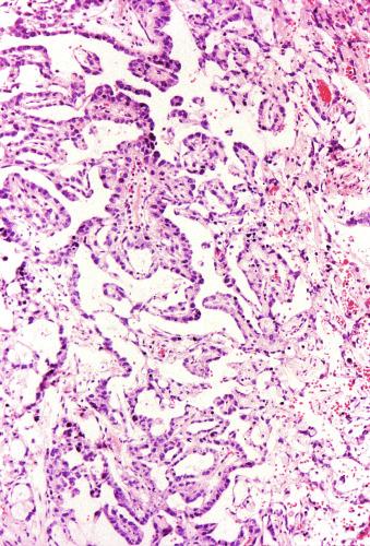 Fig. 13.66, Oblique sections of endodermal sinuslike structures result in geographic configurations with festoons of malignant epithelium at the periphery and a complex, labyrinthine pattern of interconnecting, extracellular spaces.