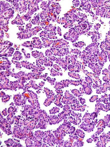 Fig. 13.67, Papillary yolk sac tumor with a single layer of hobnail-type cells on fibrovascular cores.