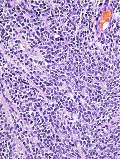 Fig. 13.69, Solid areas in a yolk sac tumor composed of small, blastema-like cells.