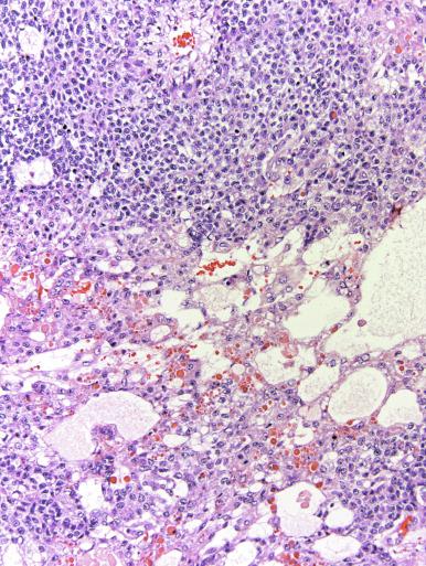 Fig. 13.70, Solid pattern of a yolk sac tumor with blastema-like focus next to more typical patterns of yolk sac tumor.