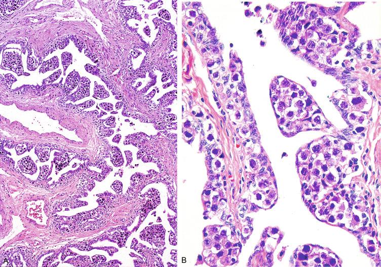 Fig. 13.7, (A and B) GCNIS cells have extended in a pagetoid fashion into the rete testis, with a layer of rete epithelium stretched over them.