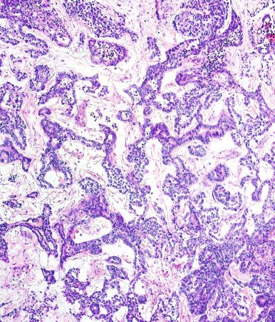 Fig. 13.72, Complex glands in a yolk sac tumor.