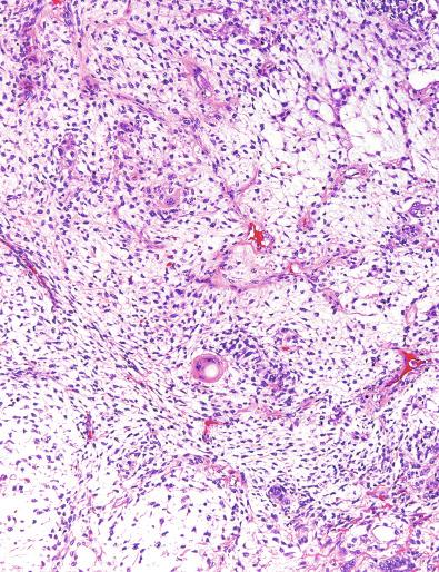 Fig. 13.73, Stellate and spindle cells with a few syncytiotrophoblasts are dispersed in a myxoid stroma in the myxomatous pattern of a yolk sac tumor. Overgrowth of this pattern justifies a diagnosis of sarcomatoid yolk sac tumor.