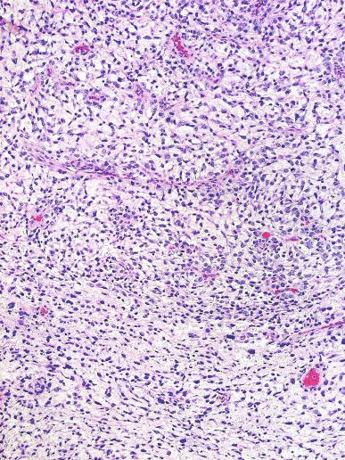 Fig. 13.75, Sarcomatoid yolk sac tumor with a myxoid background.