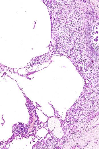 Fig. 13.76, Macrocystic pattern of a yolk sac tumor.