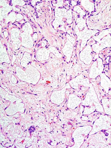 Fig. 13.77, Polyvesicular vitelline pattern of a yolk sac tumor is composed of irregular, often constricted, vesicle-like structures lined by flattened epithelium in loose stroma.