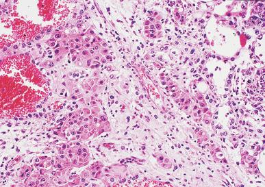 Fig. 13.78, Hepatoid pattern of a yolk sac tumor.