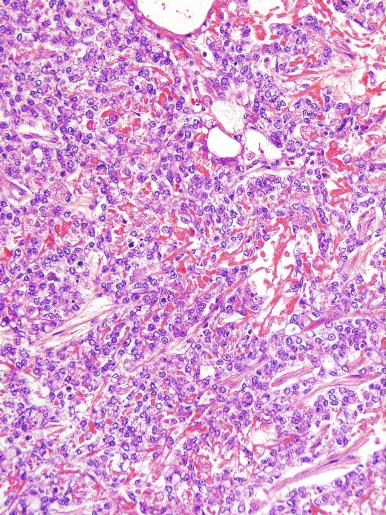 Fig. 13.80, Bands and irregularly shaped deposits of basement membrane constitute parietal differentiation in a yolk sac tumor.