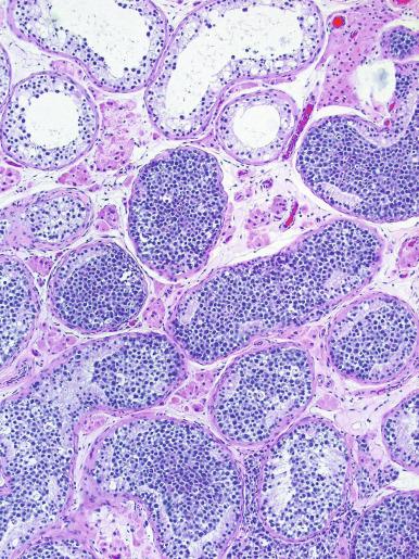 Fig. 13.8, Distension of seminiferous tubules by seminoma-like cells is referred to as “intratubular seminoma.”