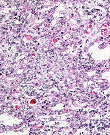 Fig. 13.81, Solid and microcystic patterns of a yolk sac tumor with eosinophilic, hyaline globules.