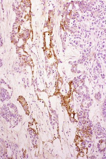 Fig. 13.82, Patchy immunoreactivity for alpha-fetoprotein in a yolk sac tumor.