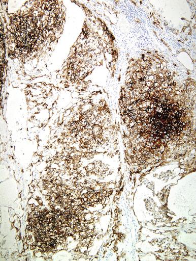 Fig. 13.83, Yolk sac tumor with glypican-3 immunoreactivity.