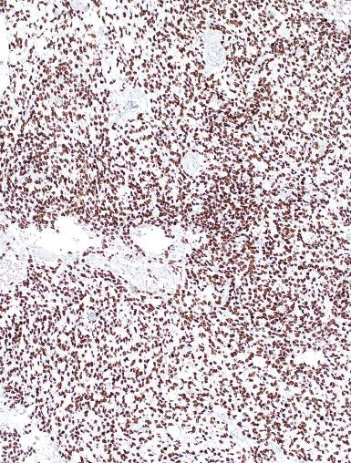 Fig. 13.84, Yolk sac tumor with SALL4 diffuse nuclear immunoreactivity.