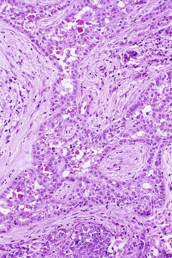 Fig. 13.85, Rete testis hyperplasia with hyaline globules.