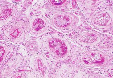 Fig. 13.9, Cytoplasmic glycogen in GCNIS is demonstrated by a periodic acid-Schiff stain.