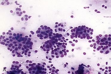 Fig. 28-1, Fine-needle aspiration biopsy (FNAB), follicular adenoma.