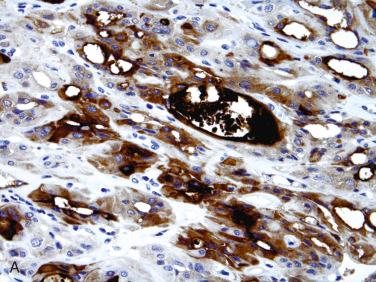 Fig. 28-11, Hyalinizing trabecular adenoma/tumor, immunohisotochemical staining.