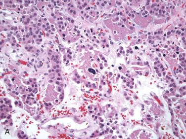 Fig. 28-12, Atypical follicular adenoma.