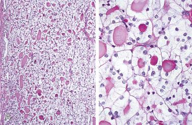 Fig. 28-13, Follicular adenoma with clear cells.