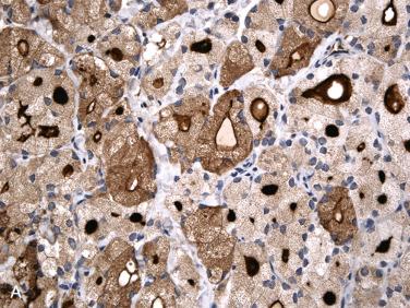 Fig. 28-14, Immunohistochemical staining in follicular adenoma with clear cells.