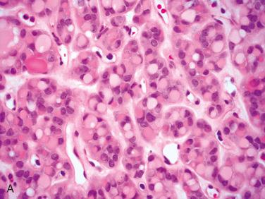 Fig. 28-15, Follicular adenoma with signet ring cells.