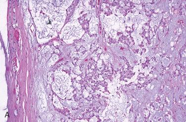 Fig. 28-17, Follicular adenoma with mucinous stroma.