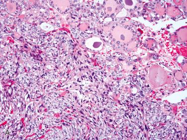 Fig. 28-18, Follicular adenoma with spindle cells.