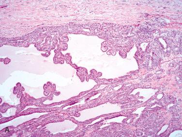 Fig. 28-19, Follicular adenoma with papillary architecture.