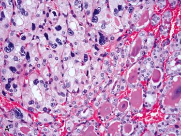 Fig. 28-20, Follicular adenoma with nuclear atypia (endocrine atypia).