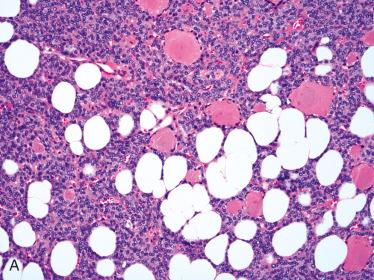 Fig. 28-21, Follicular adenoma with mesenchymal components.