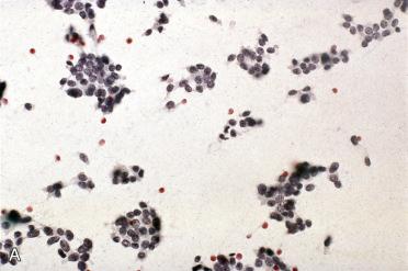 Fig. 28-22, Fine-needle aspiration biopsy of a solitary, solid thyroid mass.