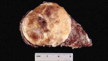 Fig. 28-23, Follicular carcinoma.