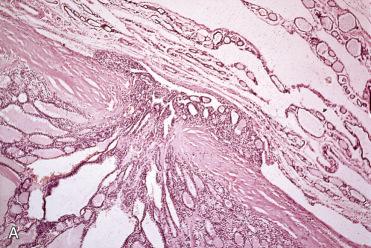 Fig. 28-24, Follicular carcinoma with capsular invasion.