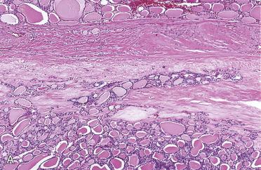 Fig. 28-26, Equivocal capsular invasion.