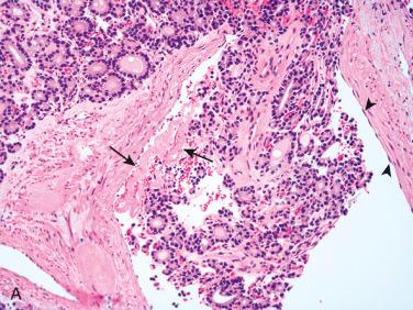 Fig. 28-27, Follicular carcinoma with vascular invasion.