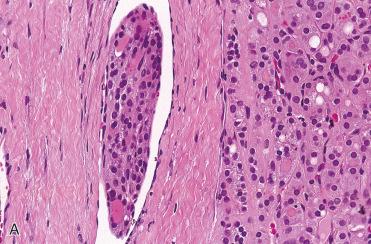 Fig. 28-29, Vascular invasion.