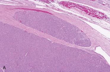 Fig. 28-30, Separate but histologically similar nodule(s).