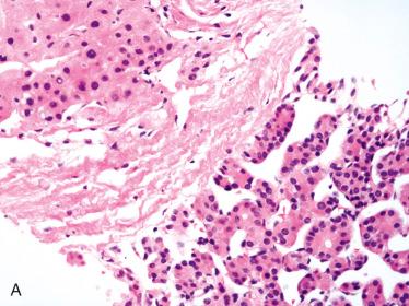 Fig. 28-31, Metastatic follicular carcinoma.