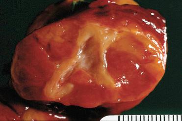 Fig. 28-32, Follicular carcinoma, oncocytic type.