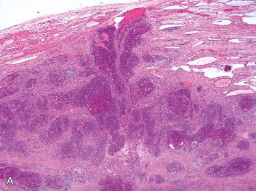 Fig. 28-33, Follicular carcinoma, oncocytic type.