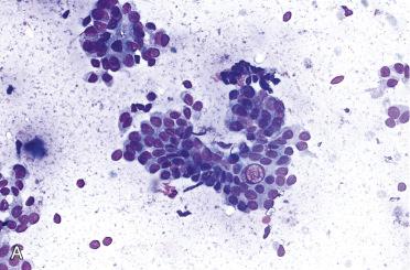 Fig. 28-34, Papillary thyroid carcinoma, fine-needle aspiration biopsy (FNAB).