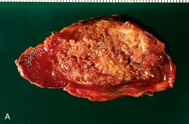 Fig. 28-35, Papillary thyroid carcinoma.