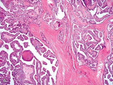 Fig. 28-37, Papillary thyroid carcinoma.