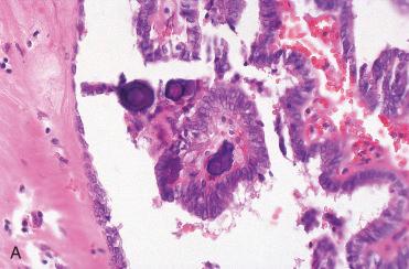 Fig. 28-38, Papillary thyroid carcinoma.