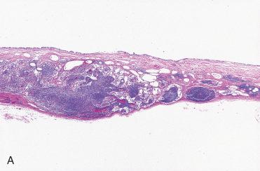 Fig. 28-44, Cystic metastatic papillary thyroid carcinoma.