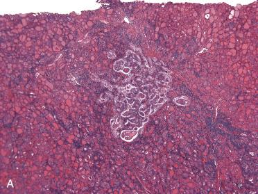 Fig. 28-47, Papillary microcarcinoma.