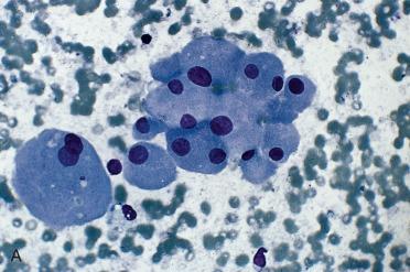 Fig. 28-7, Fine-needle aspiration biopsy (FNAB), follicular adenoma, oncocytic type.