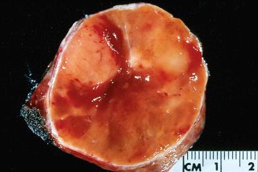 Fig. 28-8, Follicular adenoma, oncocytic type.