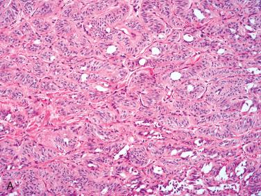 Fig. 28-10, Hyalinizing trabecular adenoma/tumor.